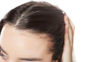 Female Hair Loss Causes — Is It Testosterone?